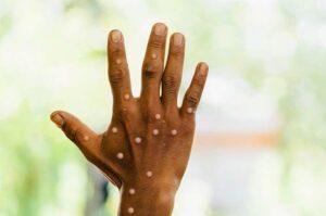 Dinkes Samarinda Berdiri Teguh untuk Mencegah Penyebaran Mpox, Layanan Informasi dan Labkesda Tersedia